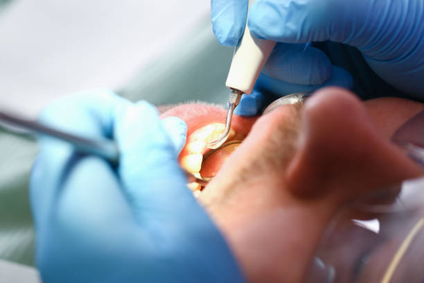 Best Emergency Tooth Extraction in Coldwater, OH